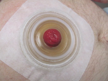 Proper fit of a skin barrier around a stoma